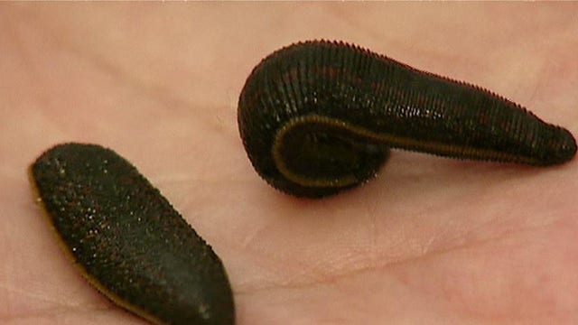 Want to lose weight? Try leech therapy