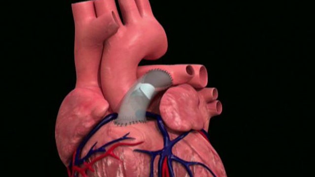 Students Design Heart Valve for Children