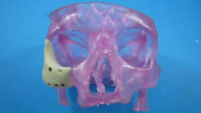 3D printed implants help with facial reconstruction