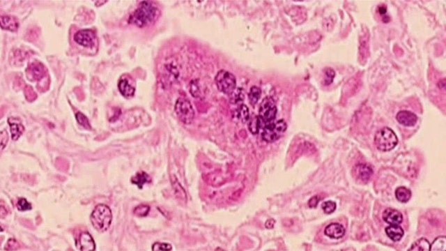 14 infants quarantined after possible measles exposure