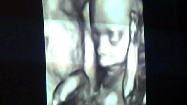 3D-4D ultrasounds worth potential risk to your unborn child?