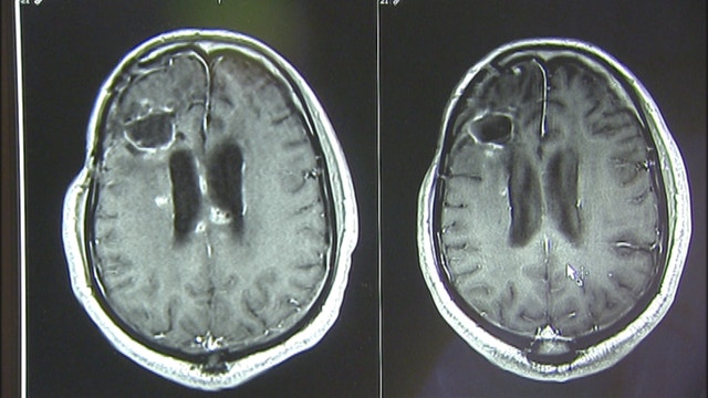 New device kills brain tumors