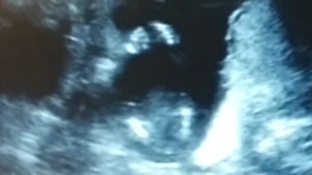 Baby appears to clap during ultrasound