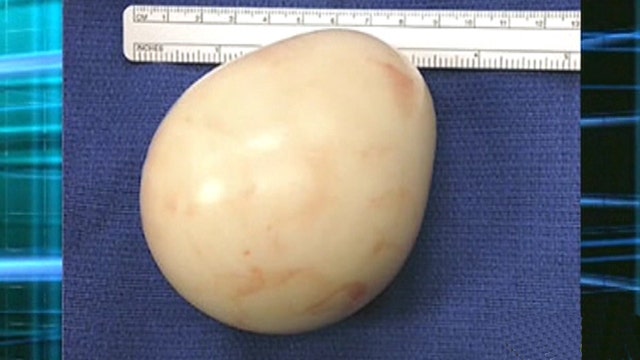 Doctors remove giant 'egg' pressing against man's bladder