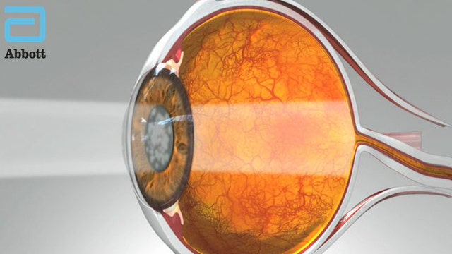 New cataract surgery eliminates need for glasses