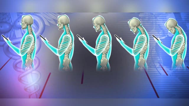 Shocking x-rays show kids suffering from 'text neck'