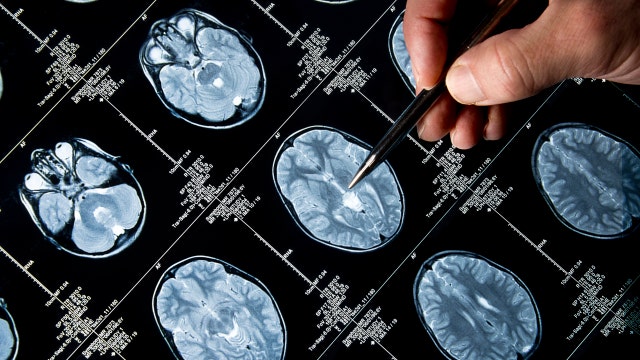 Looking back at how far we’ve come in Alzheimer’s research