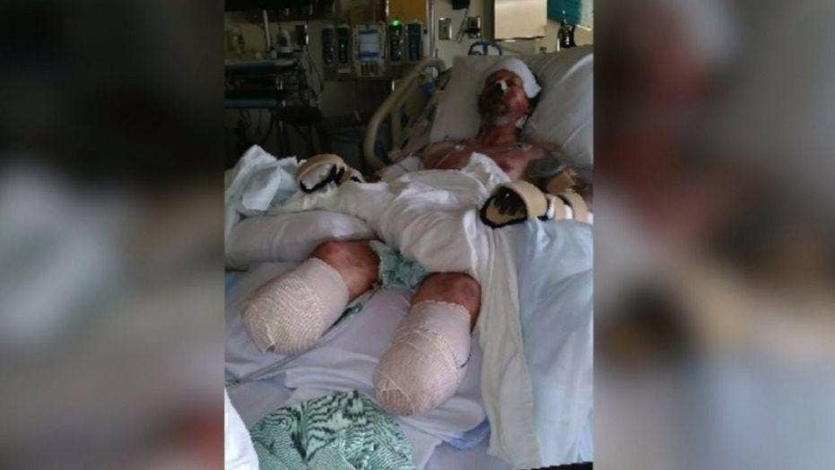 Man has 4 limbs amputated after dog lick leads to severe infection, report says