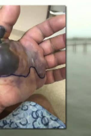 Is 'flesh-eating' bacteria at YOUR beach?