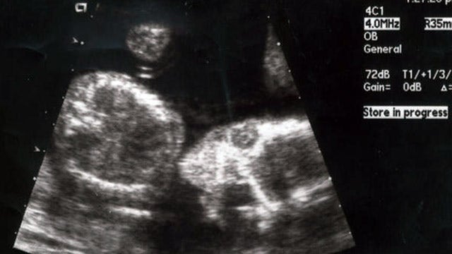 Should American law protect unborn children from harm?