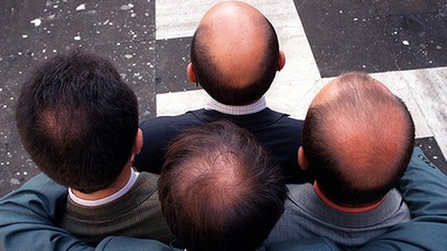 Balding linked to heart disease in men