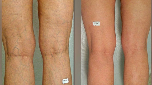 Pain-free solution for spider veins