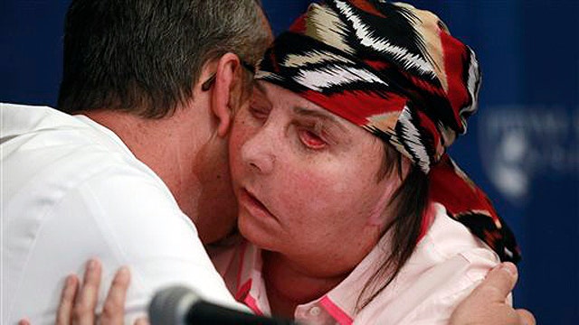 Vermont woman disfigured in attack reveals new face