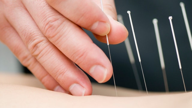 Relieving stress with acupuncture