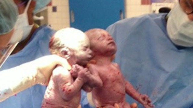 Twin girls born holding hands