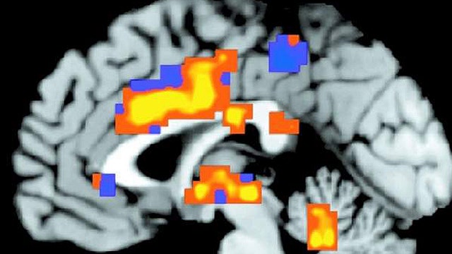 Brain scan may help diagnose depression