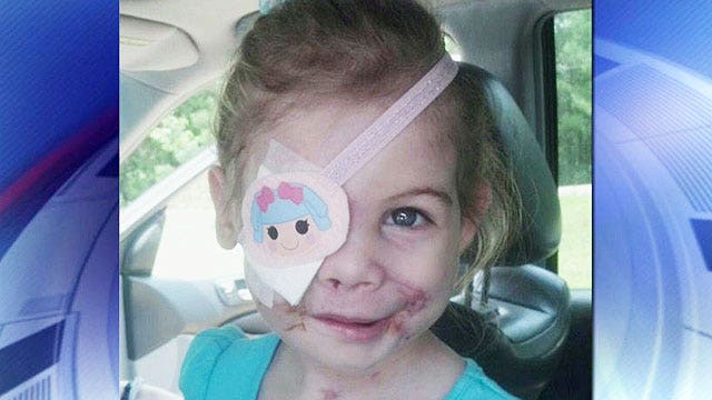 Young girl asked to leave KFC because of her scars
