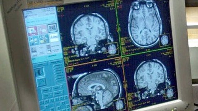 Test for Alzheimer's disease creates controversy