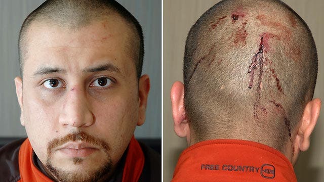 Medical report: The key evidence in Zimmerman trial?