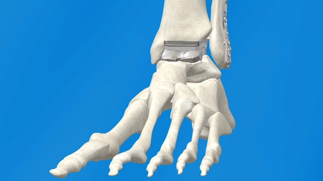 New ankle replacement surgery