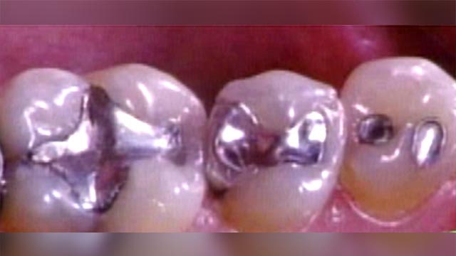 Are silver dental fillings dangerous?