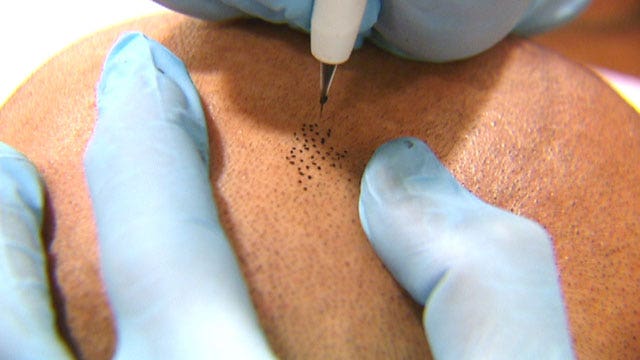 New solution for hair loss| Latest News Videos | Fox News New solution for hair loss| Latest News Videos | Fox News