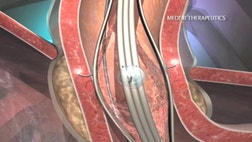 >Over 15 million Americans suffer from gastroesophageal reflux disease, or GERD. Check out how new technology is using radiofrequency to help reshape the muscles of the esophagus and offer lasting relief