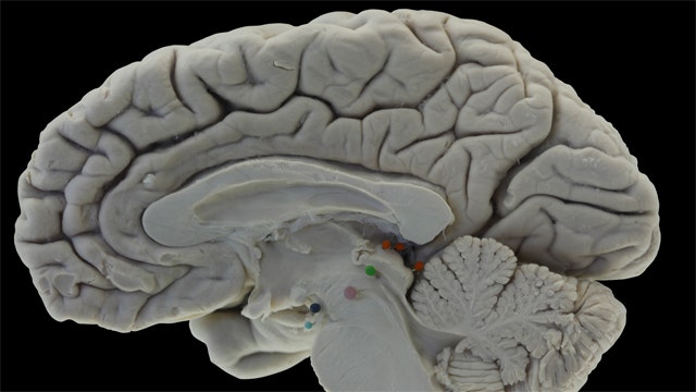 Biomarkers may assist in Alzheimer's detection