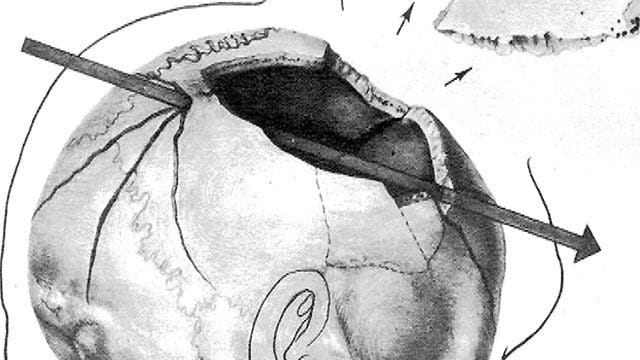 Skull X-rays raise questions about bullet that killed JFK