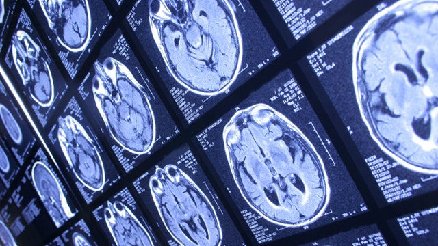 Brain cancer breakthrough, no-cut biopsy, sugar risk