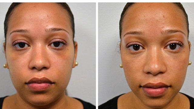 Quick Plastic Surgery for Under Eye Circles
