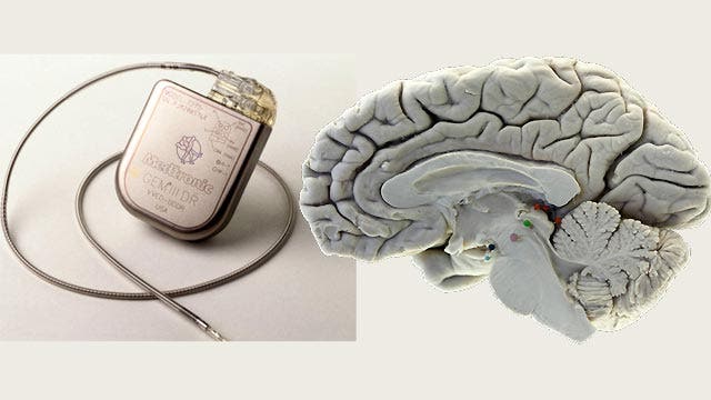 'Brain pacemaker' tested on Alzheimer's patients