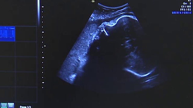 FDA warns against doing extra ultrasounds for 'keepsakes'