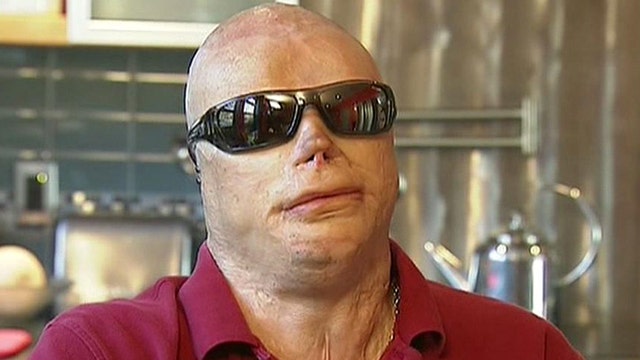 Nightclub Fire Survivor Thriving After Hand Transplant