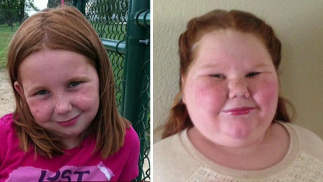 Insurer denies 12-year-old girl weight-loss surgery