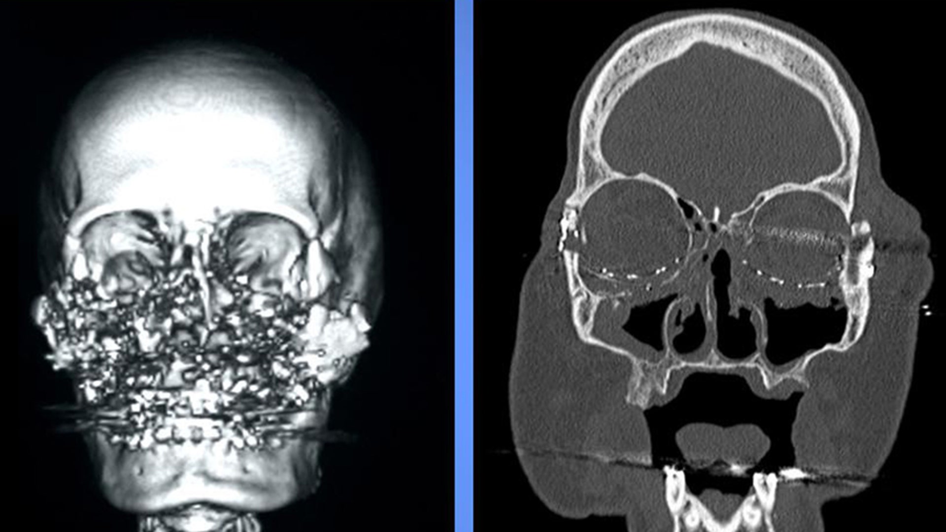 Facial first picture transplant