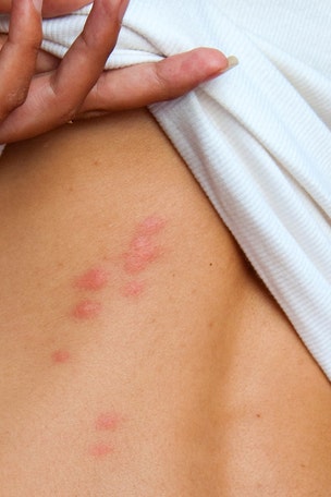 How to care for BUG BITES