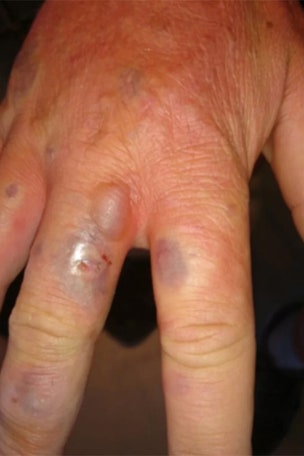 Hiker left with 'zombie' skin