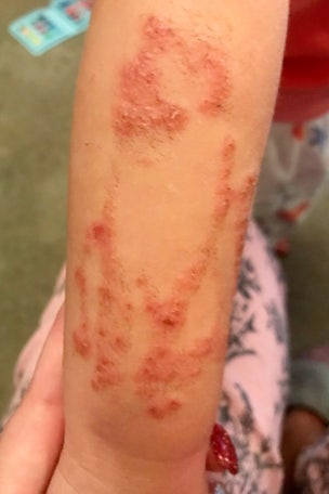 Girl scarred by vacation activity