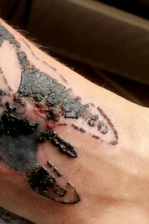 Cheap tattoo landed her in hospital
