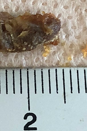 Doc sucks THIS out of patient's ear: 'Look at that!'
