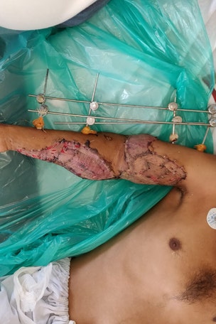 Man's arm severed by train