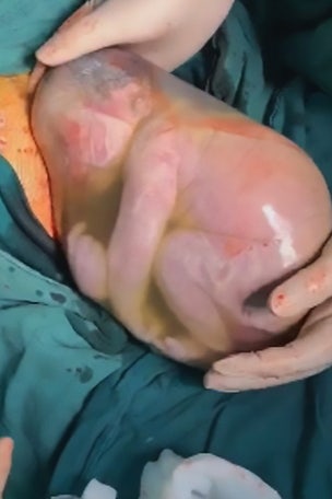 AMAZING PICS: Baby born in amniotic sac