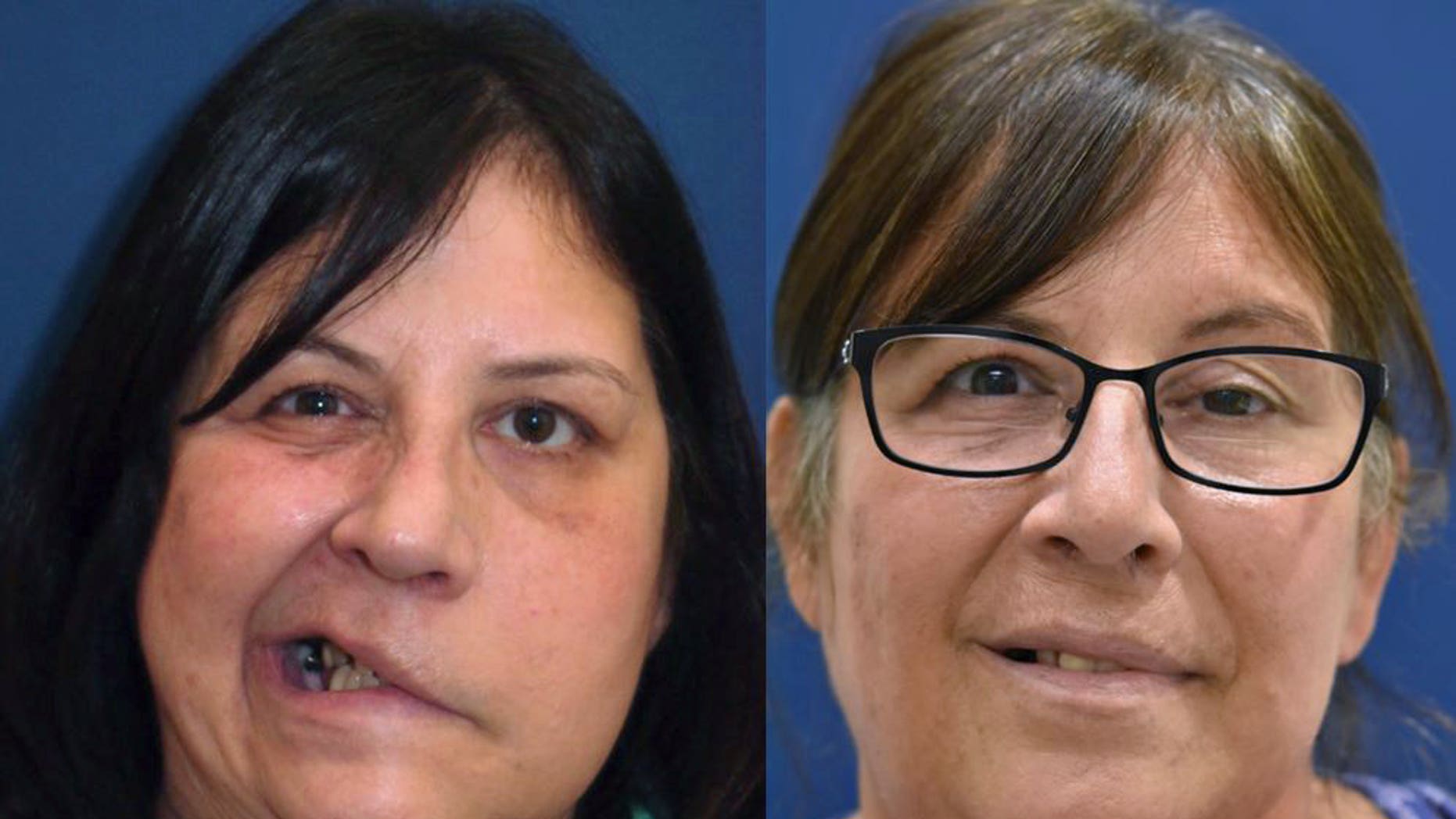 Jarmilla "Jarm" Hawes before and after a surgery that restored her smile 2.5 years after suffering a stroke.