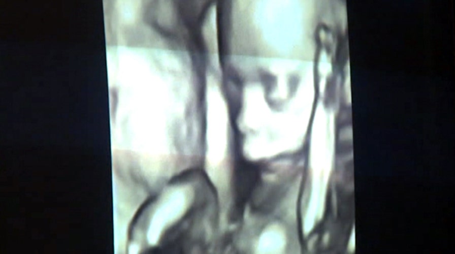 3D-4D ultrasounds worth potential risk to your unborn child?