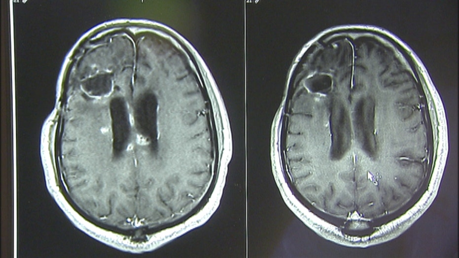 New device treats brain tumors without chemotherapy ...