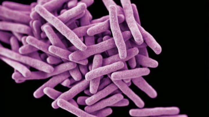 Rare strain of tuberculosis being treated in Maryland