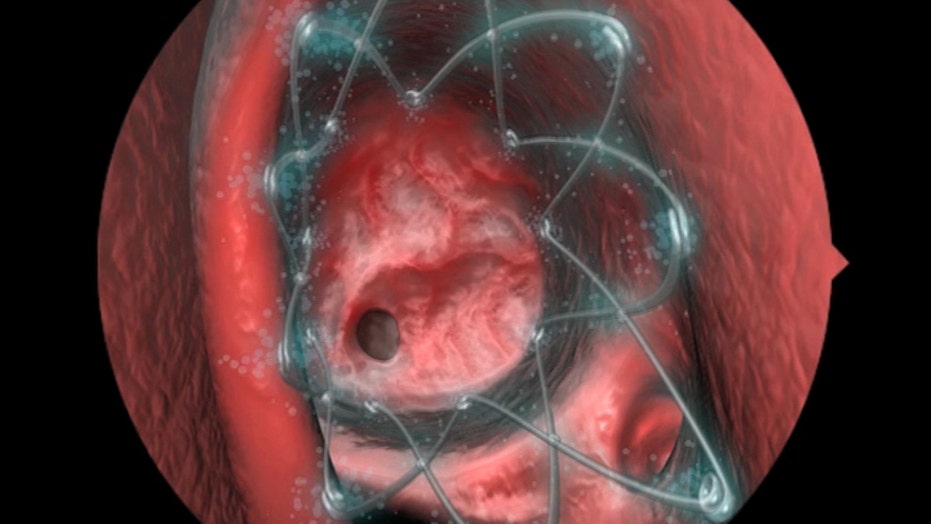 nasal sinus surgery