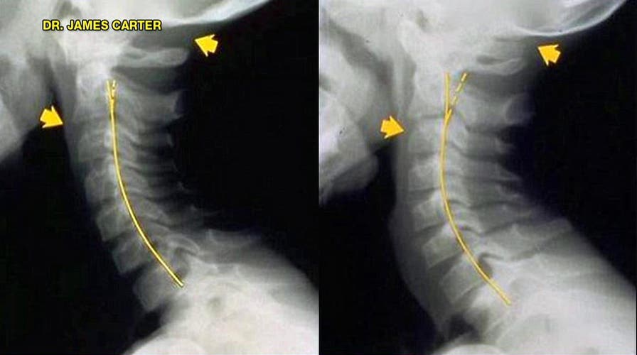 Report: Smartphones leading to 'text neck' in teens