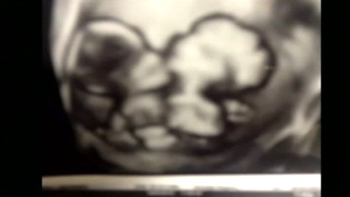 Sonogram reveals conjoined twins 'hugging'